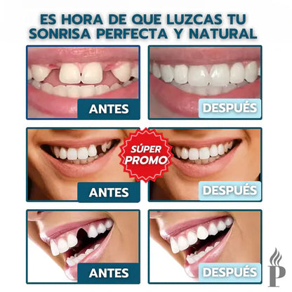 [PAGA 1 y LLEVA 2] CARILLAS DENTALES AJUSTABLES - SNAP-ON SMILE